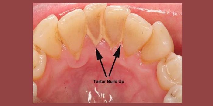 tartar buildup